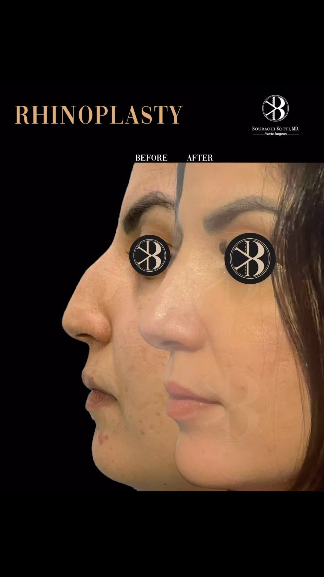 Rhinoplasty before and after Dubai — natural clinical transformation by Dr. Bouraoui Kotti