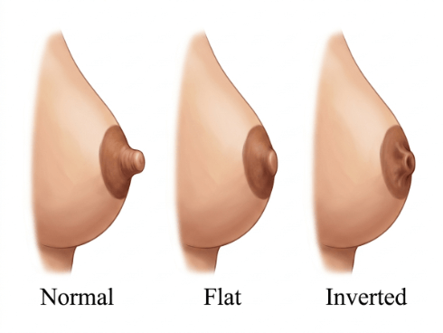 Invaginated nipple Dubai — Dr. Bouraoui Kotti