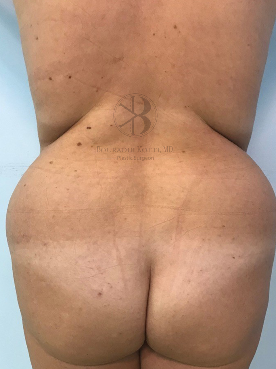 liposculpture