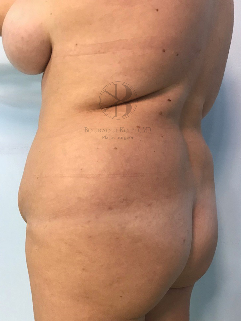 liposculpture