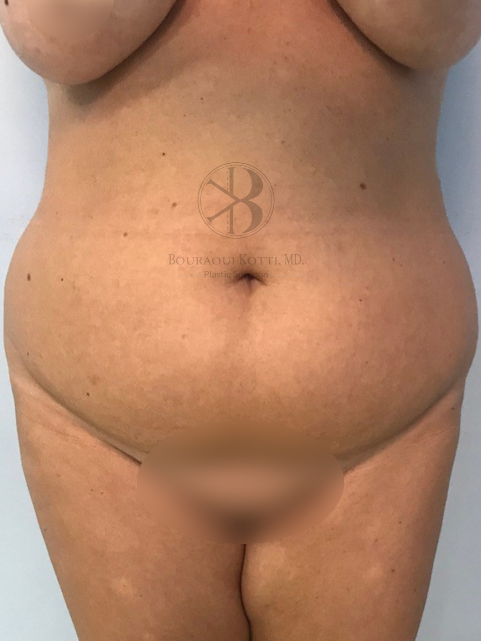 liposculpture