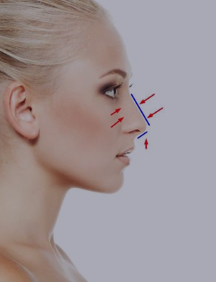 Rhinoplastie-dr-kotti