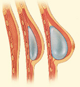 Reconstruction with tissue expansion