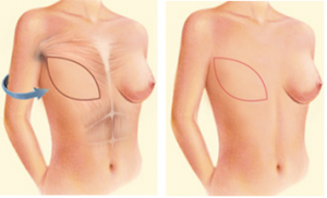 breast implant dr-kotti
