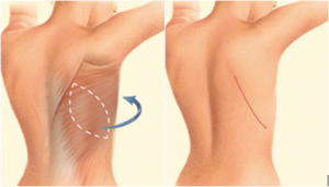 latissimus dorsi flap uses muscle