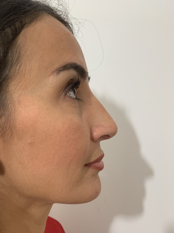 Rhinoplasty