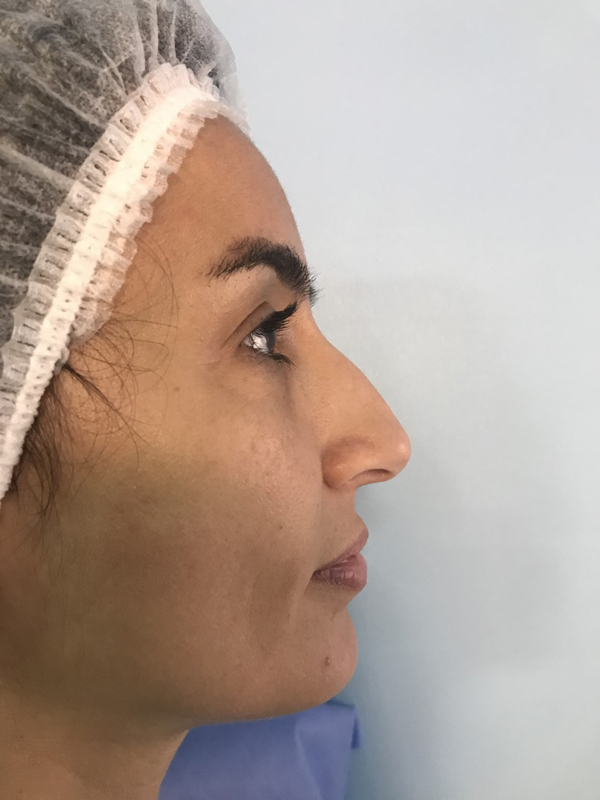 Rhinoplasty
