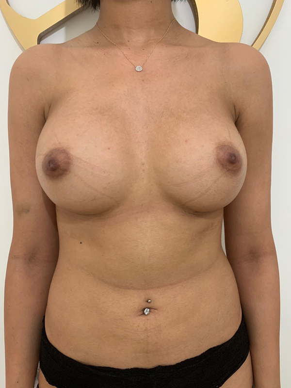 breast-augmentation