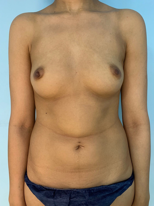 breast-augmentation