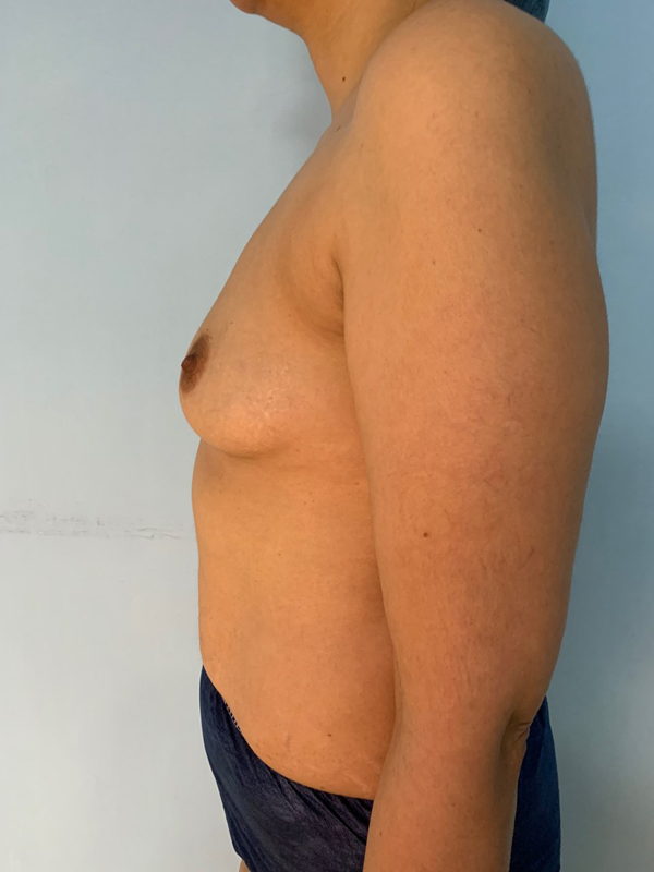 breast-augmentation