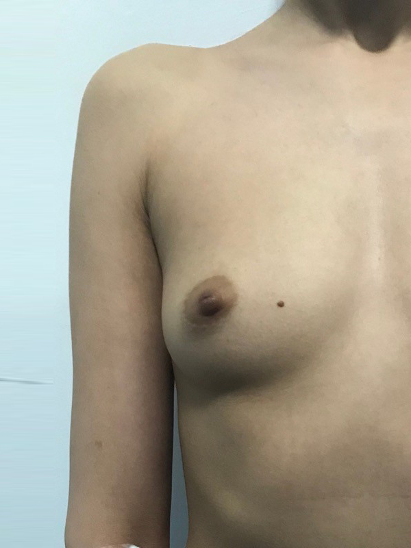 breast-augmentation