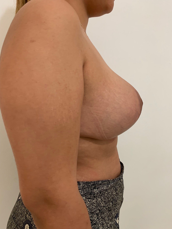 breast-reduction