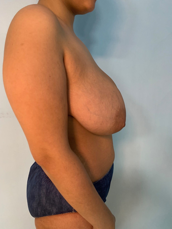 breast-reduction