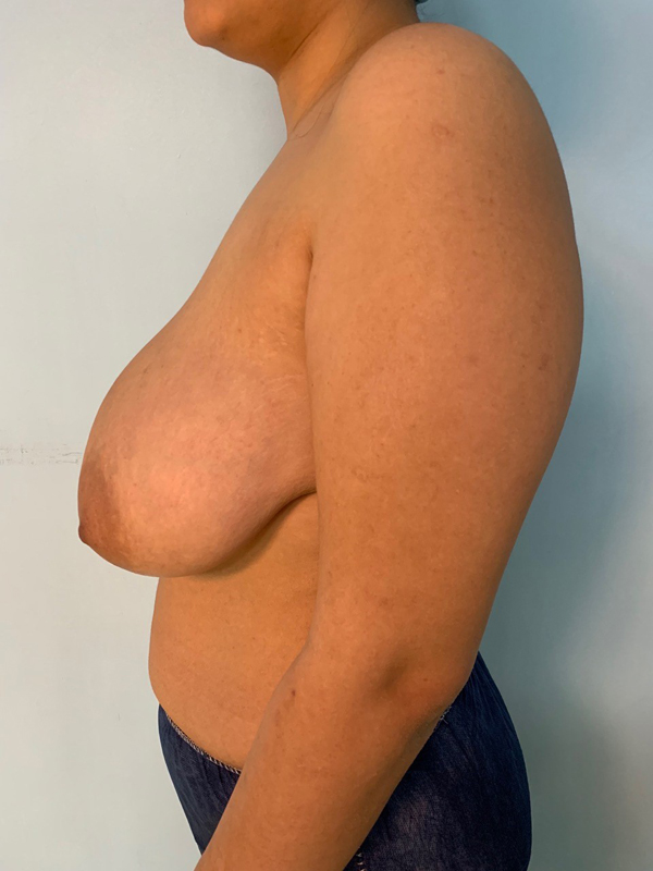 breast-reduction