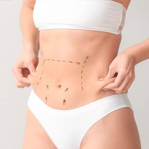 Abdominoplasty