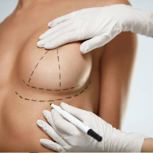 Breast augmentation and Areolar lift