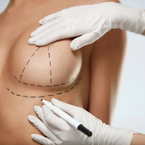 Breast lift