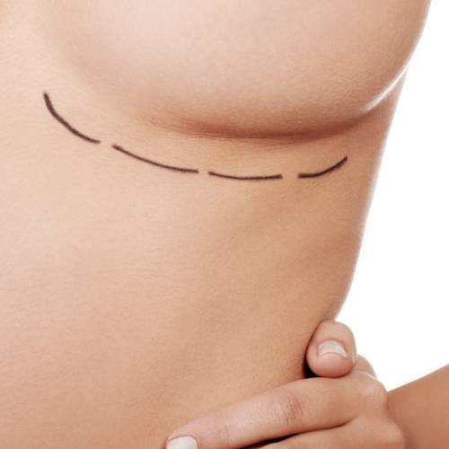 Breast lipofilling