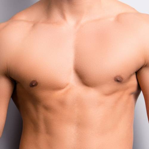 Gynecomastia