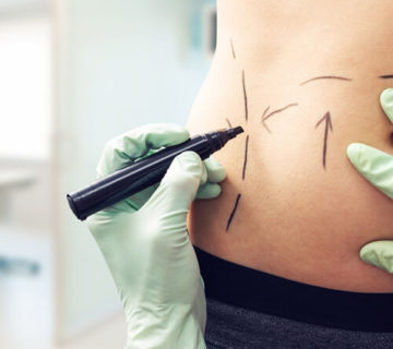 Liposuction-surgery-Dubai-Abu-Dhabi-UAE