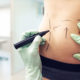 Liposuction-surgery-Dubai-Abu-Dhabi-UAE